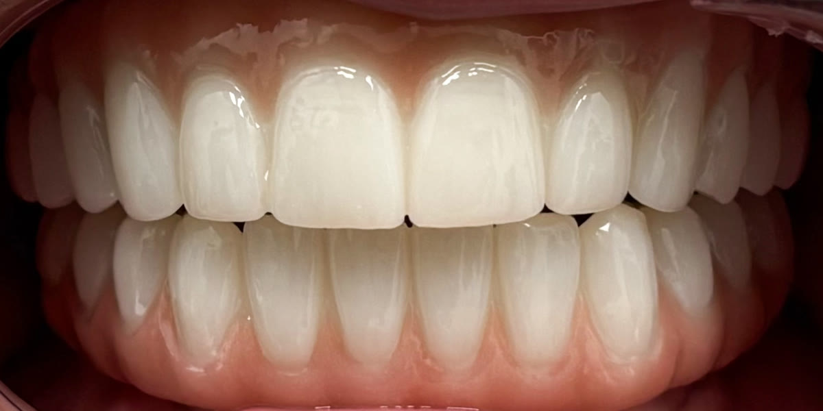 After: fixed zirconia teeth
