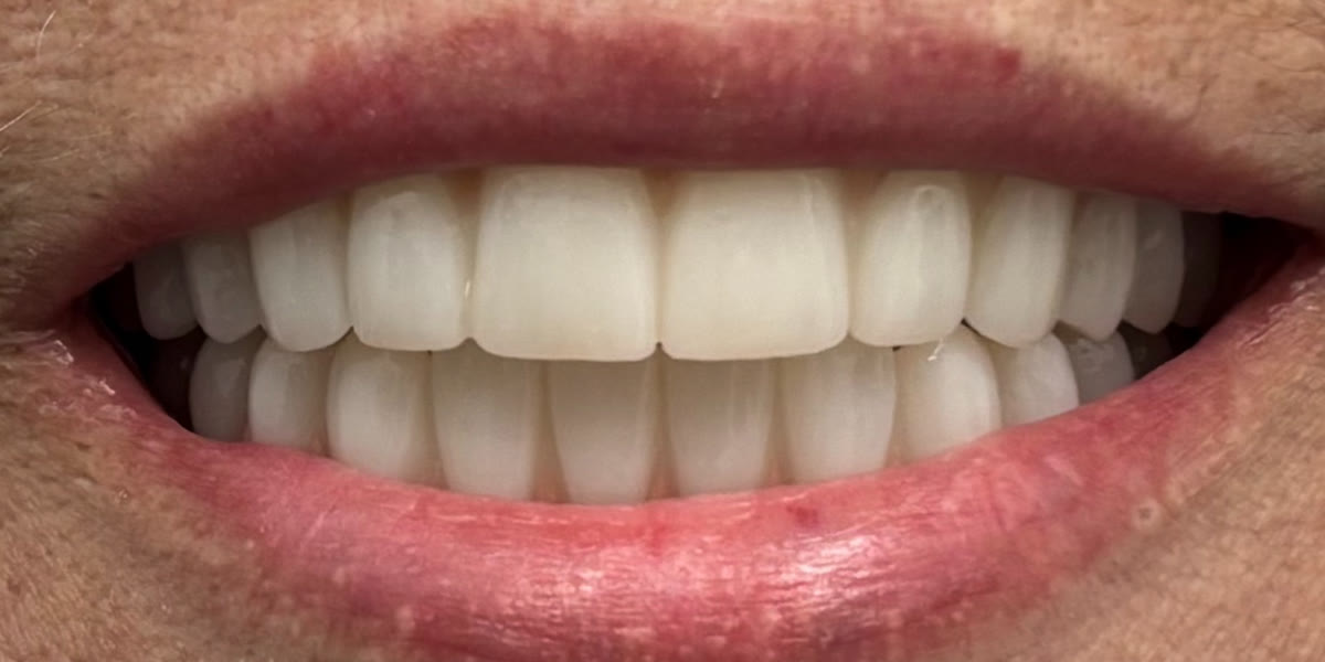 After: her new smile