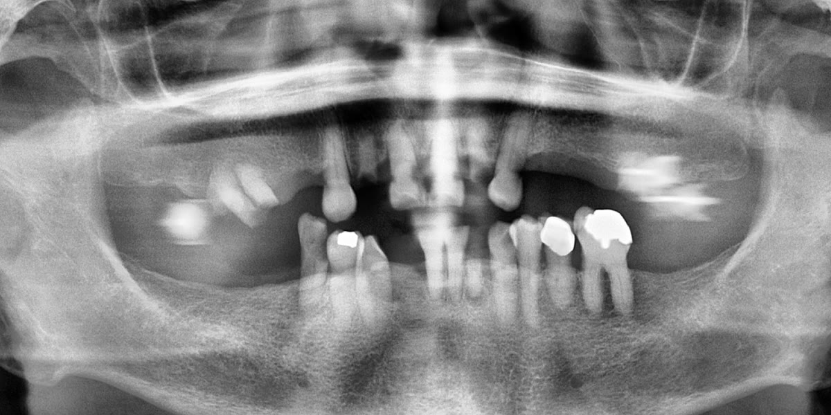 Before: panoramic X-ray