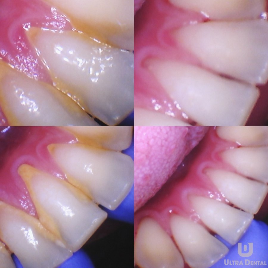 Left: before. Right: after, with the tartar cleared from the gumline.
