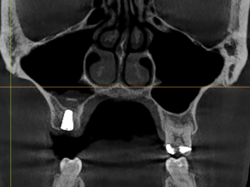 After: a new implant, planned in 3D