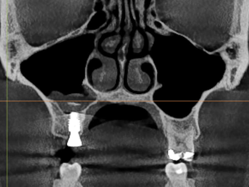 Before: an implant placed out of position