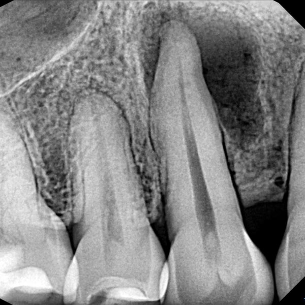 Antes: la infección se ve en la radiografía