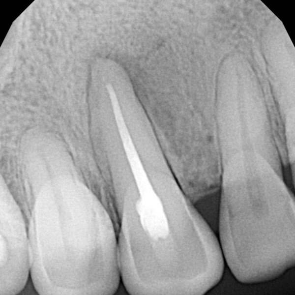 1 año después de la endodoncia