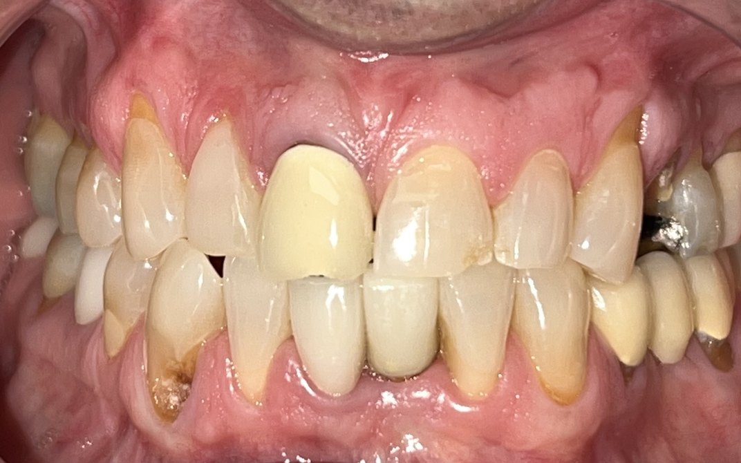 Before dental treatment