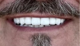 After dental treatment