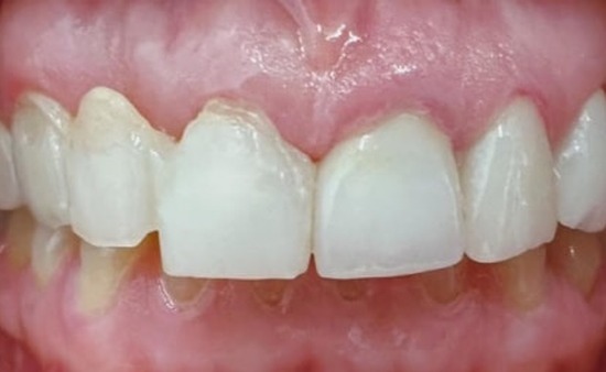 Before dental treatment