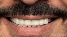 After dental treatment