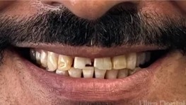 Before dental treatment