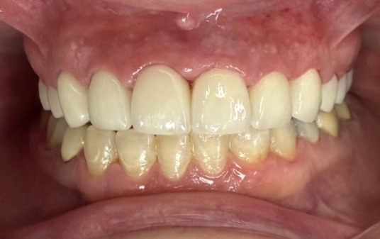 Primer plano de la sonrisa de un paciente después de un tratamiento dental cosmético