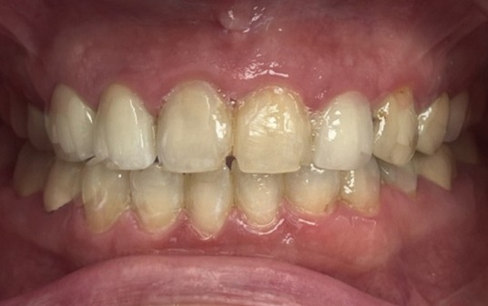 Antes del tratamiento