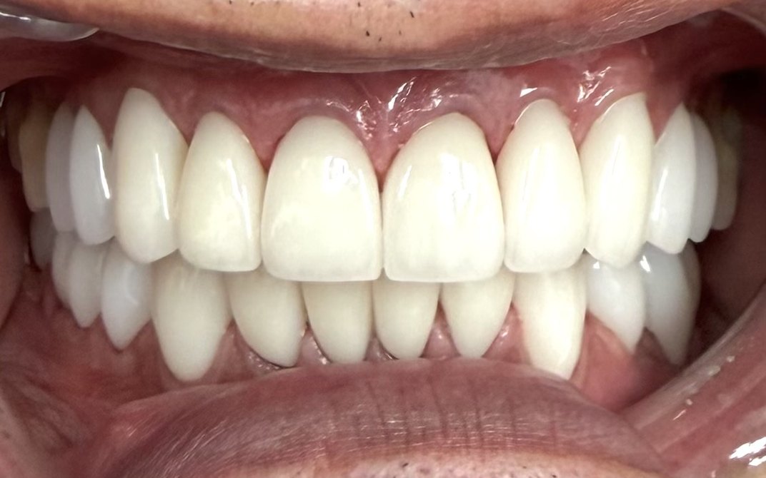 After dental treatment