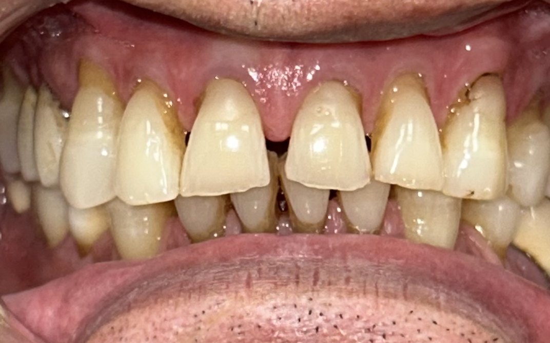 Before dental treatment