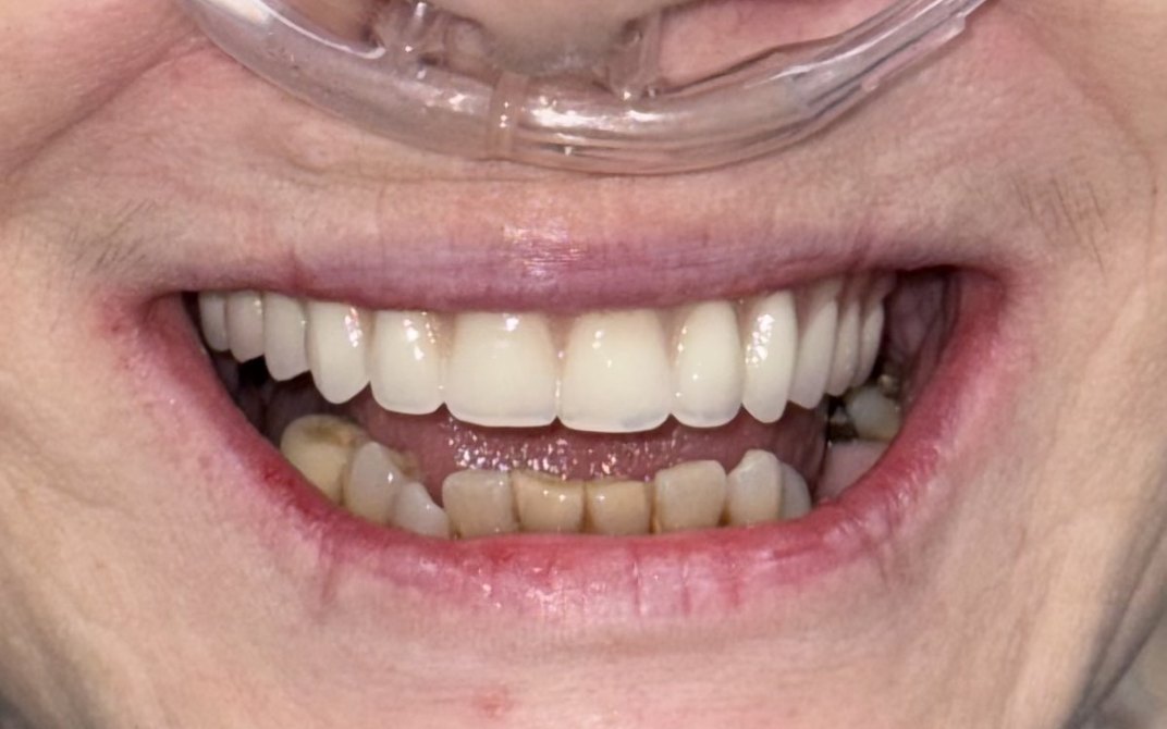 After dental treatment