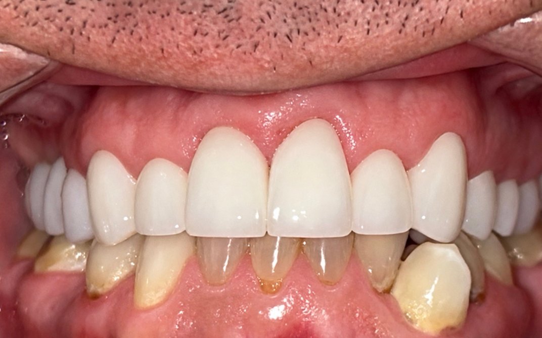 After dental treatment