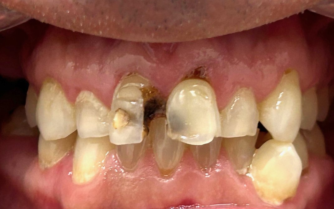 Antes del tratamiento dental