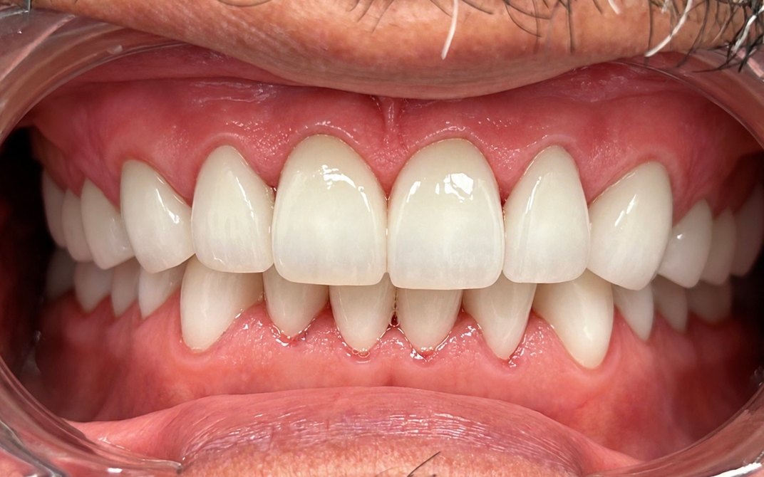 After dental treatment