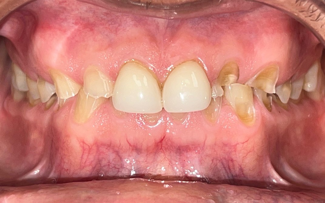 Before dental treatment