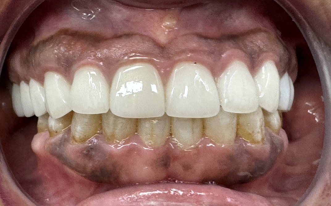Después del tratamiento dental