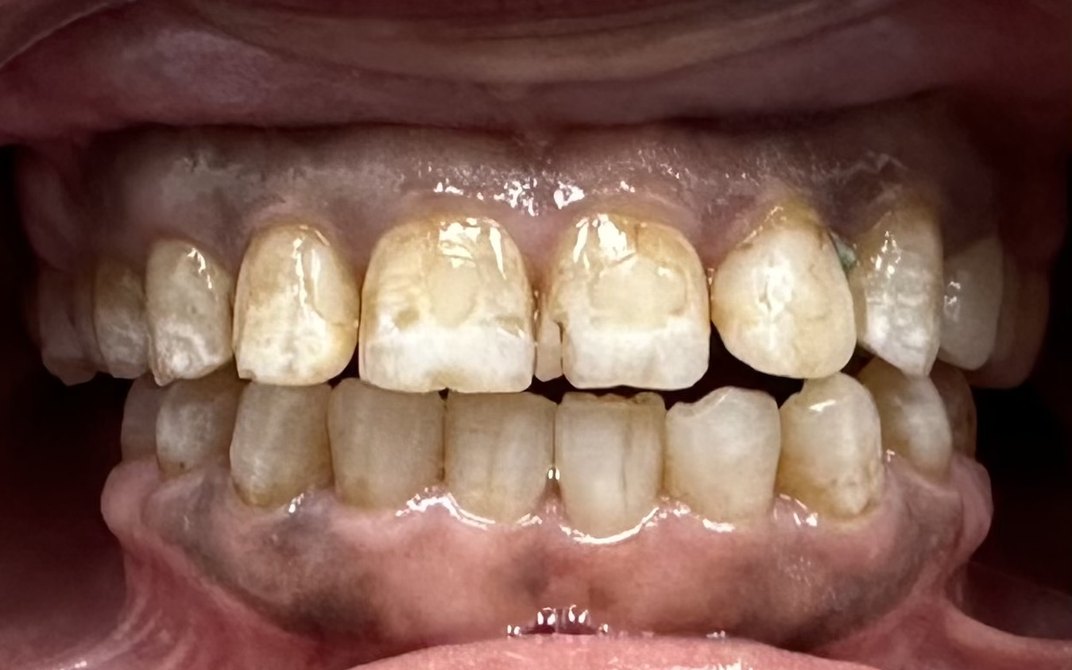 Antes del tratamiento dental