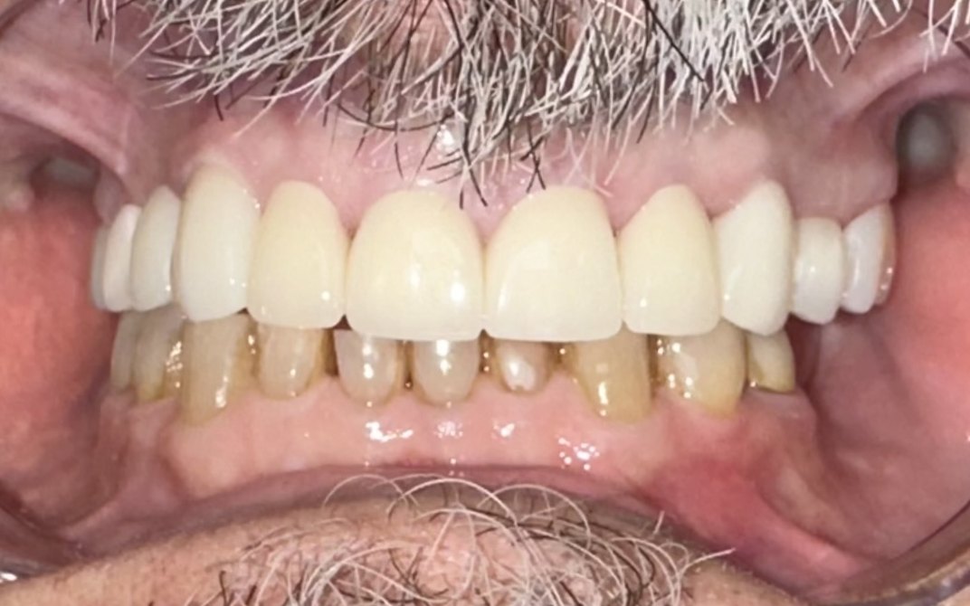 Después del tratamiento dental