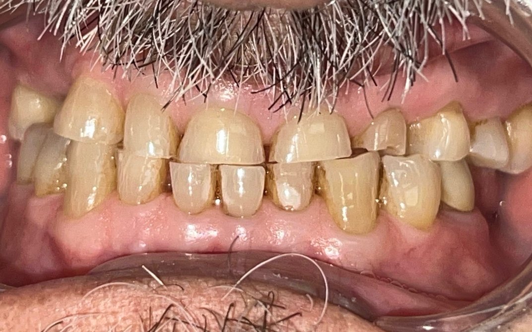 Antes del tratamiento dental