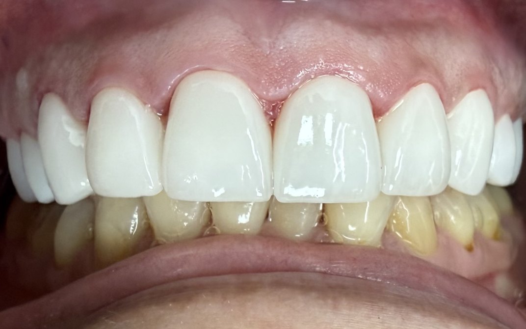 Después del tratamiento dental