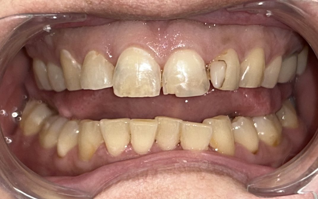 Antes del tratamiento dental