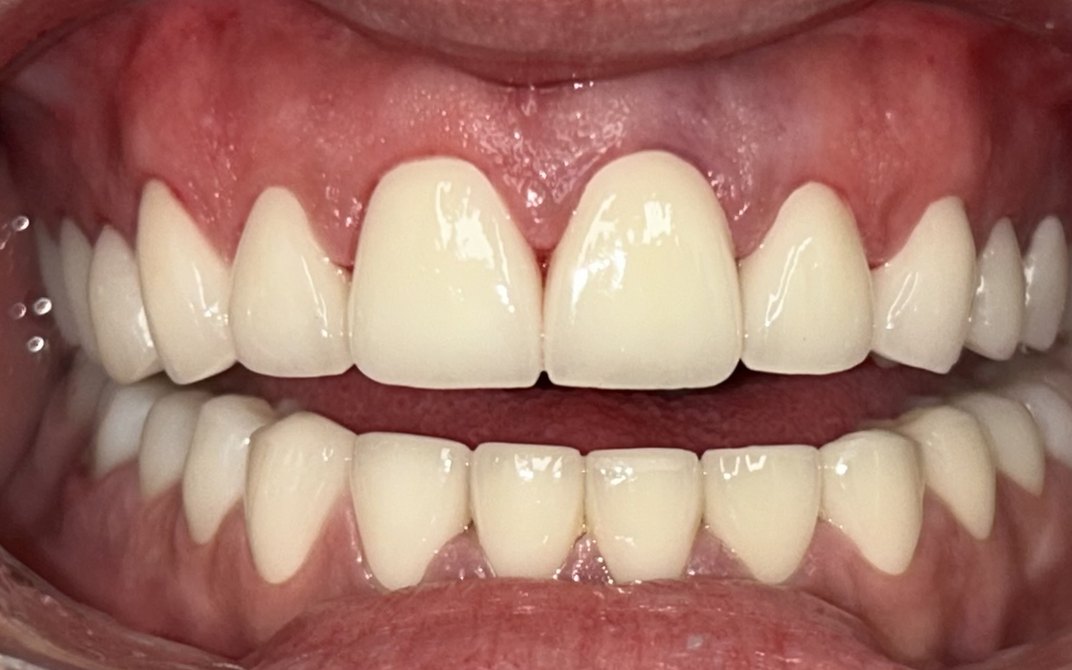 Después del tratamiento dental