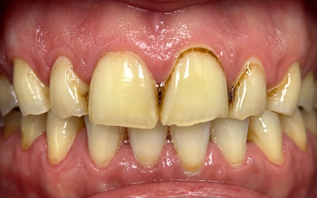Before dental treatment