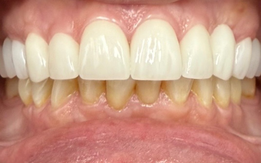 Después del tratamiento dental