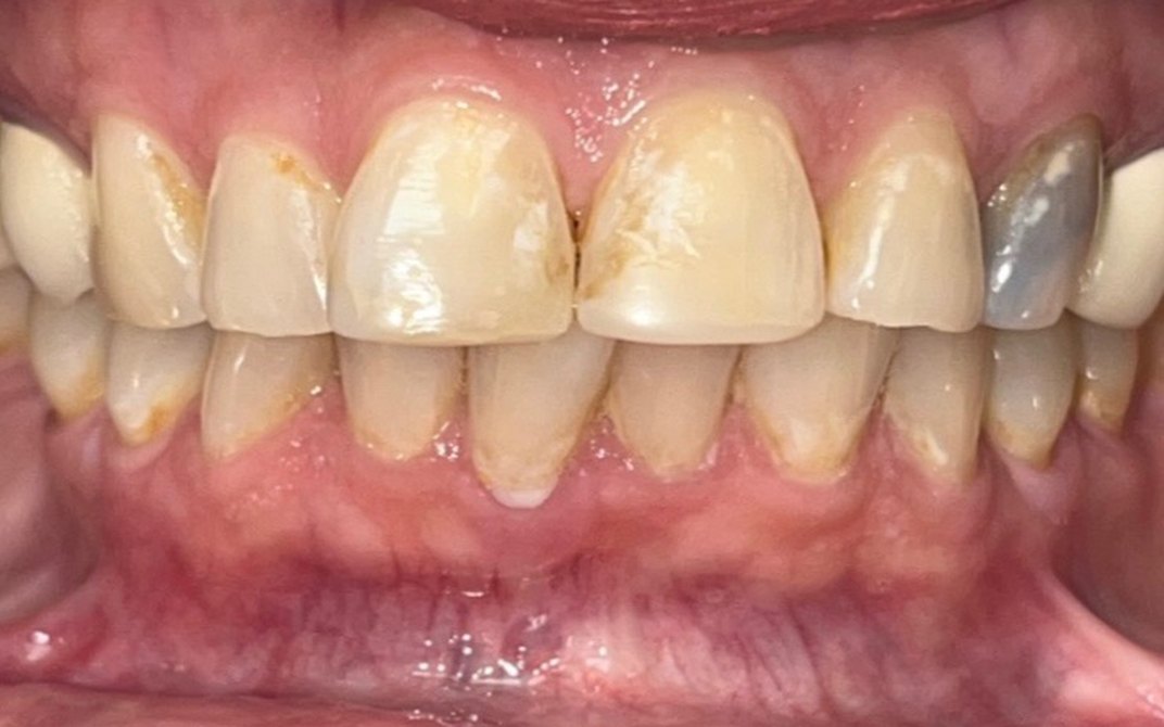 Before dental treatment
