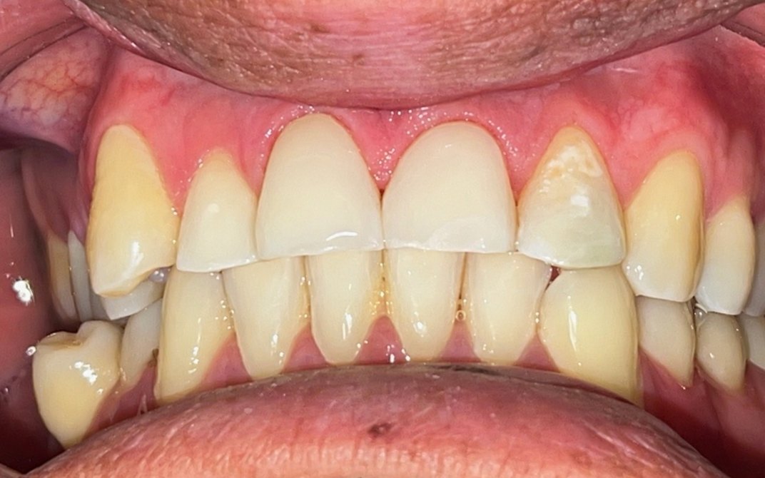 Después del tratamiento dental