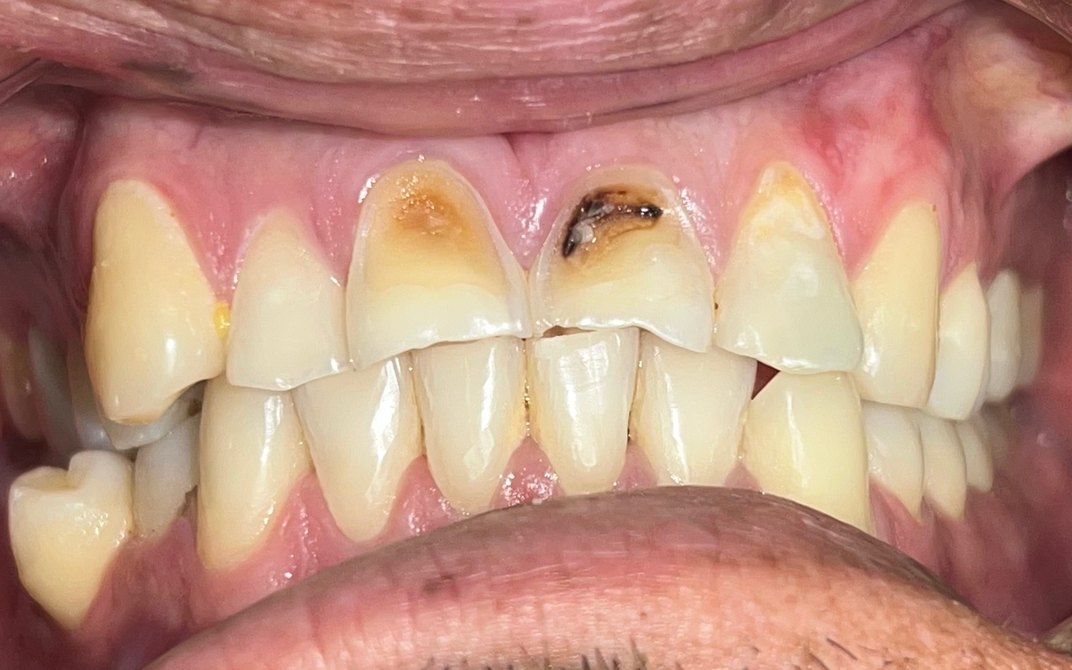 Antes del tratamiento dental