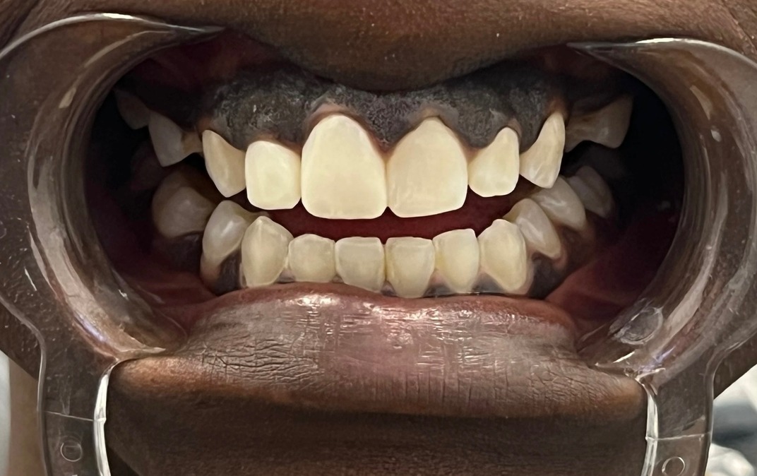 Después del tratamiento dental