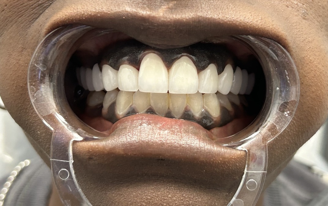 Antes del tratamiento dental
