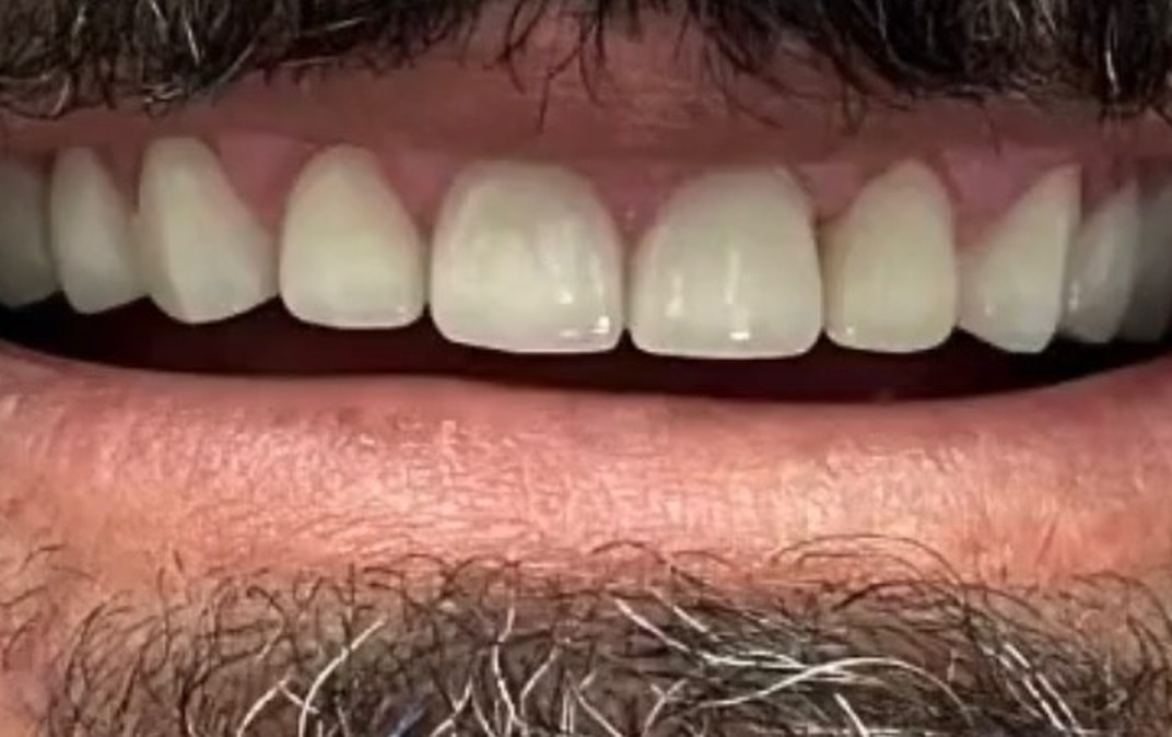 After dental treatment