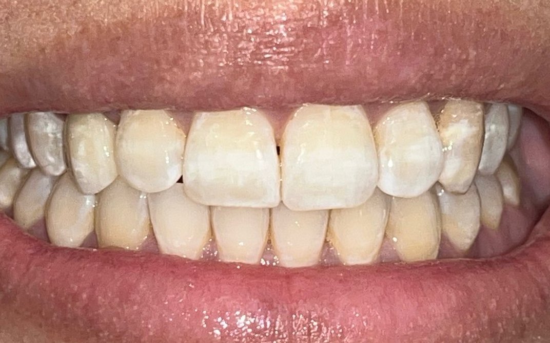 After dental treatment