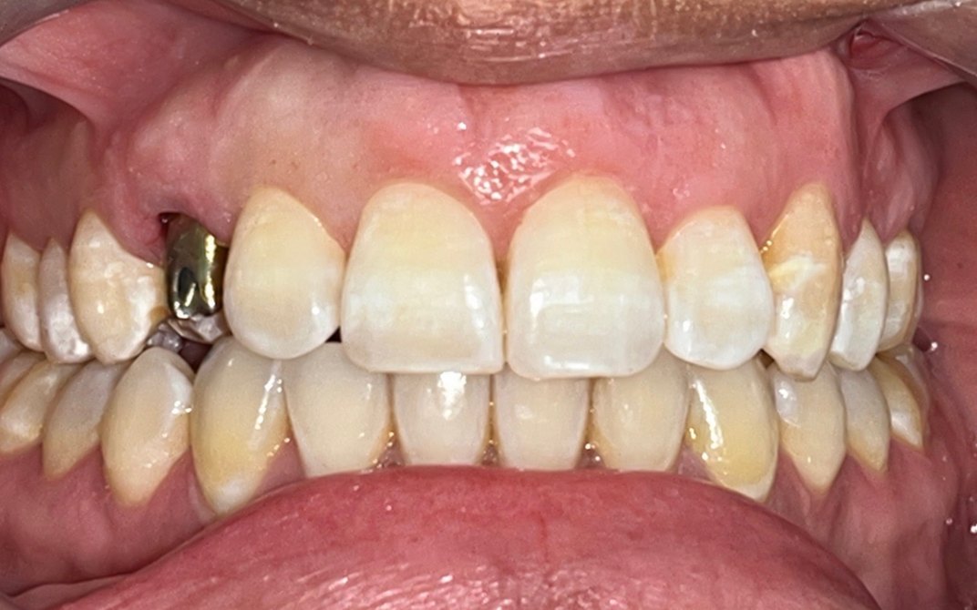 Before dental treatment