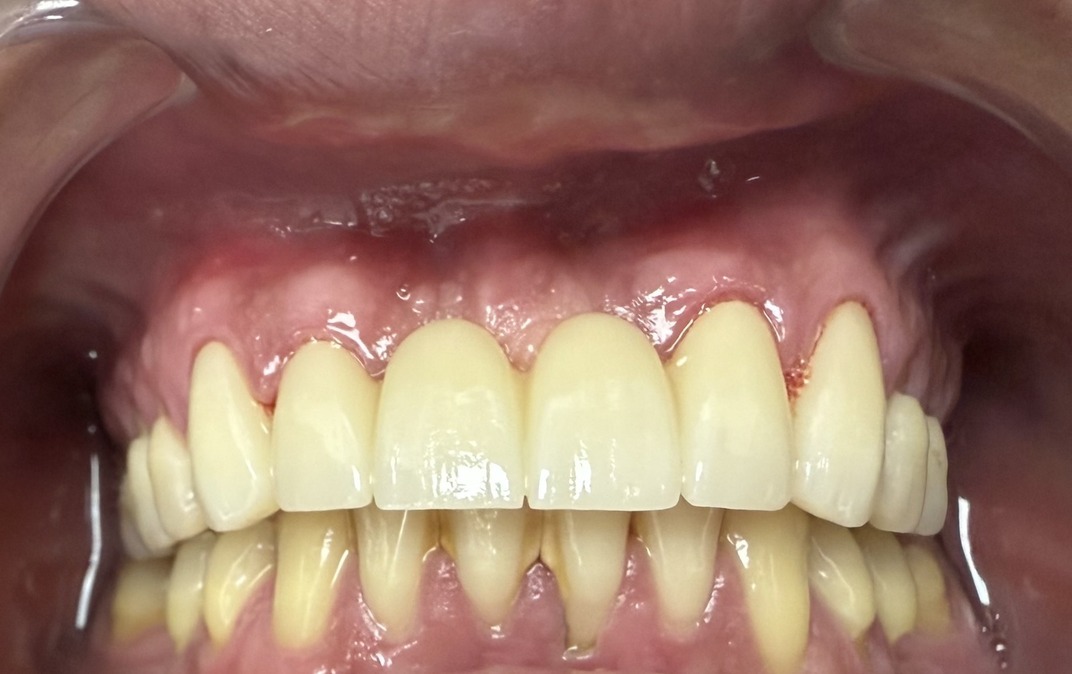 After dental treatment
