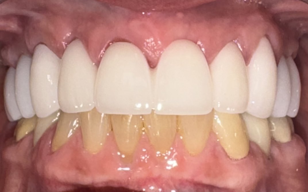 Después del tratamiento dental