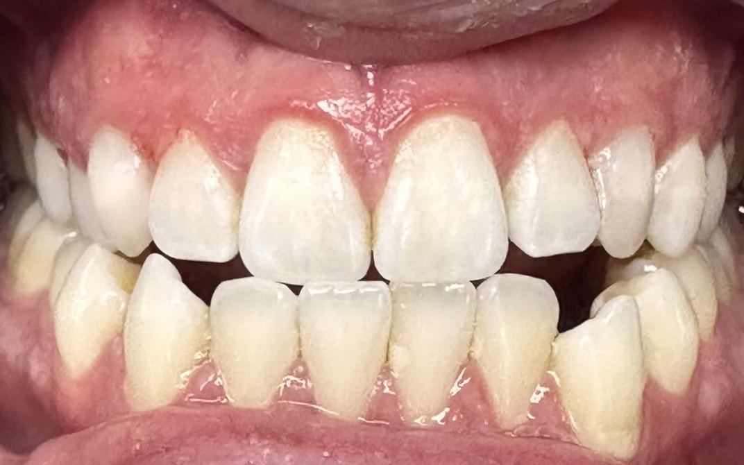 After dental treatment