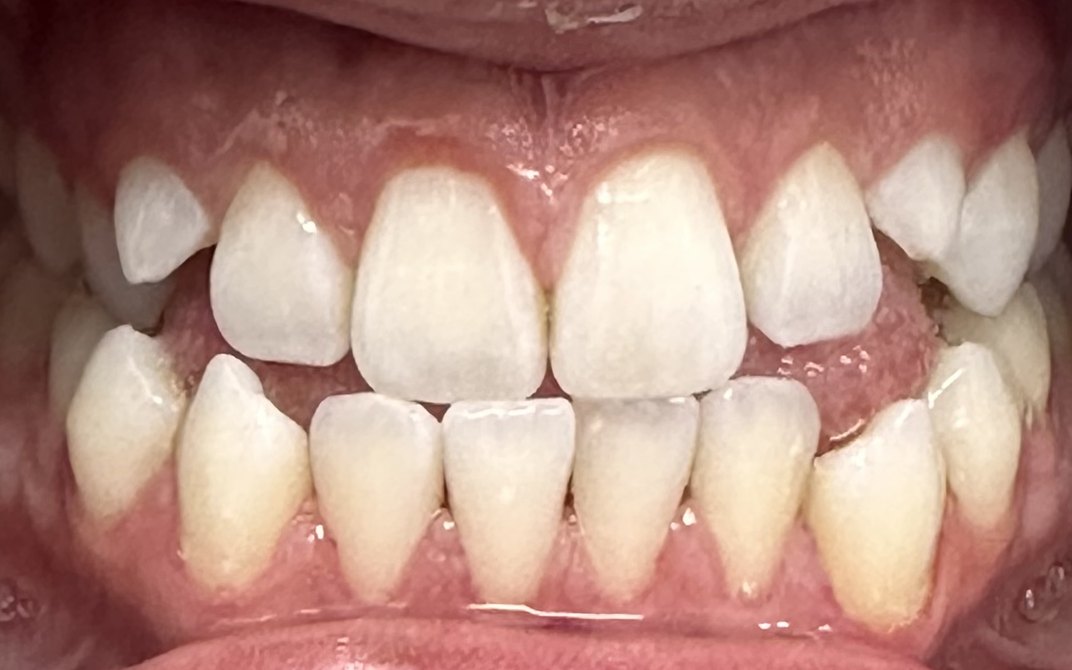 Before dental treatment