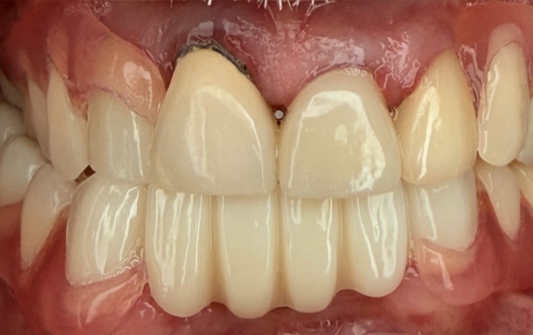 Después del tratamiento dental