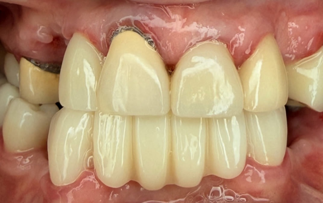 Antes del tratamiento dental