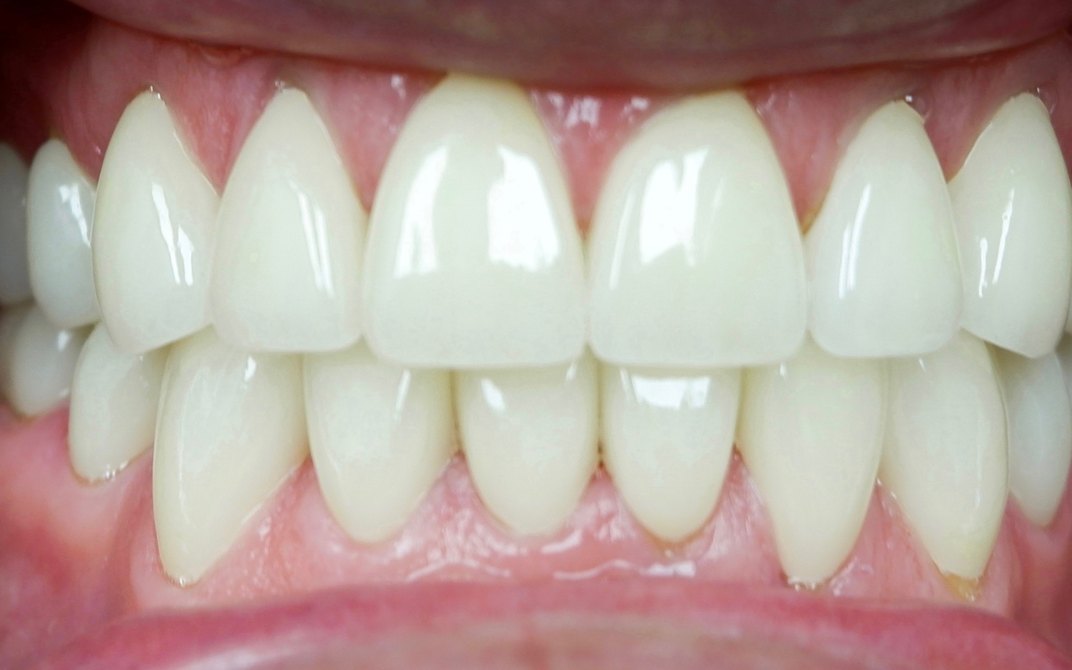 After dental treatment