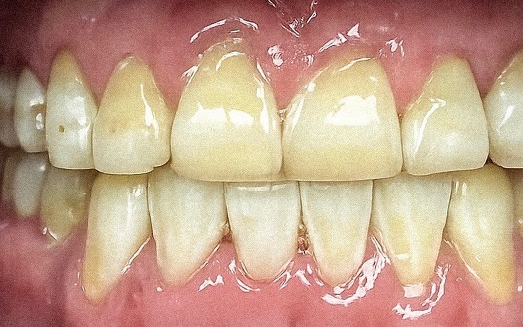 Antes del tratamiento dental