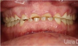 Before dental treatment