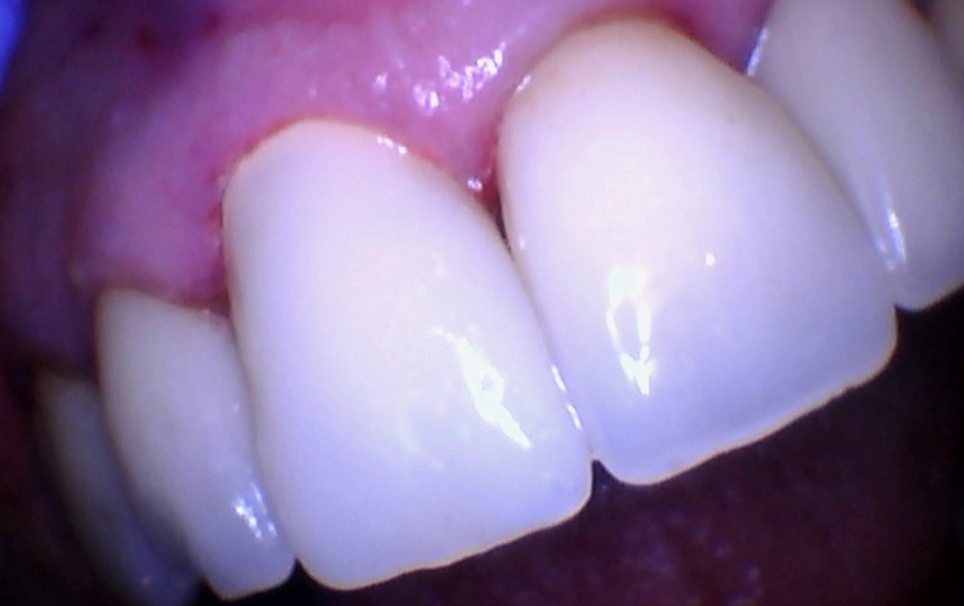 After dental treatment
