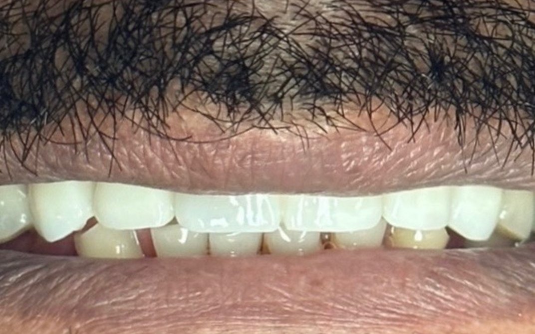 After dental treatment